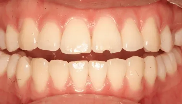 Before dental bonding