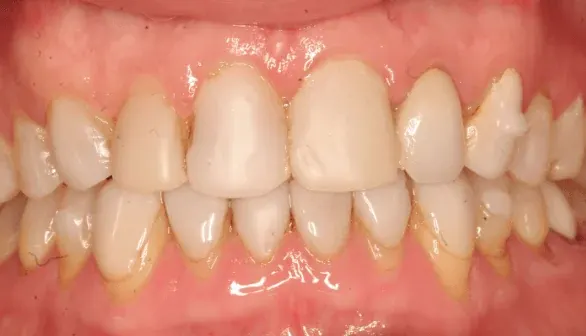 Before smile makeover at Empower Your Smile, Tribeca